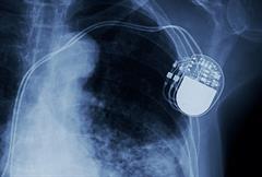 Typical implanted neuro-simulator device Typical implanted neuro-simulator device